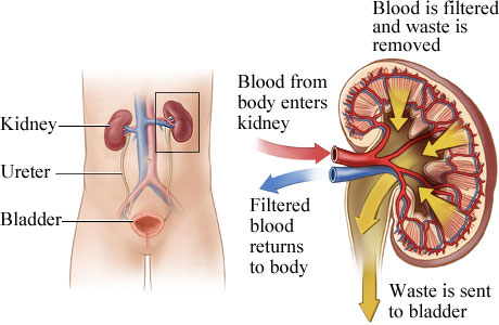 AV Fistula